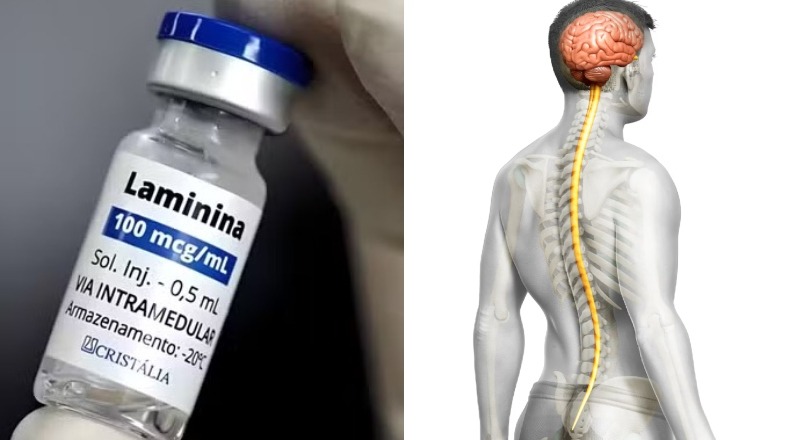 Brasil perde patente internacional da polilaminina devido a cortes de recursos na Universidade Federal.